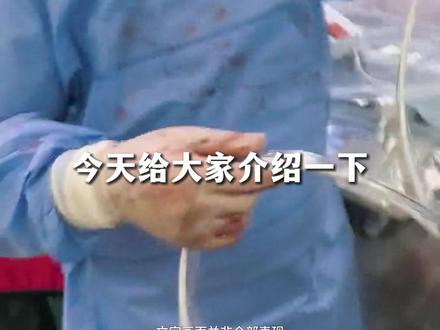 最新血管内盾构机,清除斑块血栓无需植入支架。#血管 #斑块旋切 #血栓 #武汉协和李海涛 #抖出健康知识宝藏