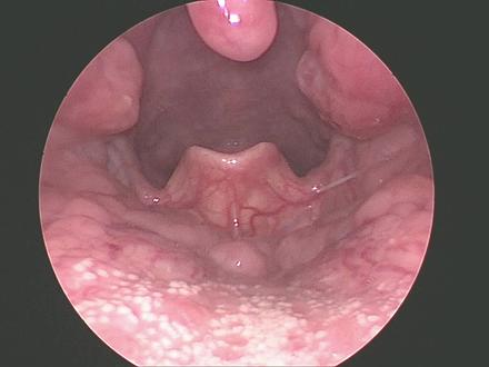 认识一下扁桃体
#医学科普
#健康科普
#医学常识