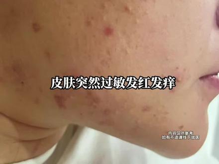 突发,发红发烫发痒,快速缓解脸部过敏#发红发烫 #干痒 #护肤 #屏障修护