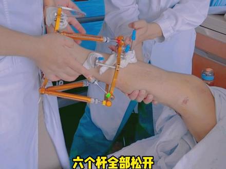 #马蹄足 矫正的必经之路——调整泰勒架!好好康复,所有的付出和忍耐会迎来好结果的! #骨科