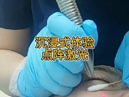 #痘坑 #点阵 这次带大家体验沉浸体验点阵激光全过程,仿佛隔着屏幕都能闻到BBQ的味道