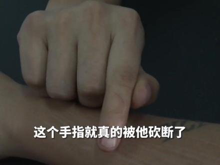 缅北回流人员自述亡命经历,手指被砍断,不听话被划近80刀,亲眼见到不打麻药被“噶腰子”