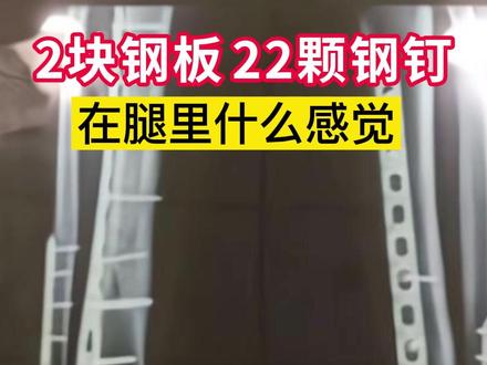 腿里打入2块钢板,22颗钢钉是什么感受#运动康复 #冬奥会 #贾宗洋