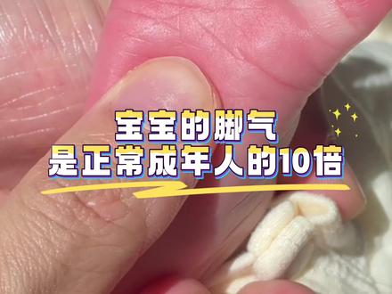 宝宝脚气是正常成年人十倍!#弹壳节目中科普育儿知识:可能与真菌传染有关 #弹壳 #育儿 #宝宝