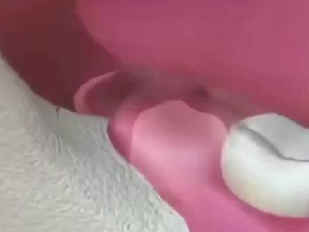 阻生智齿突然发作怎么办?快艾特给你有需要的朋友#口腔科普 #智齿冠周炎 #牙疼怎么办