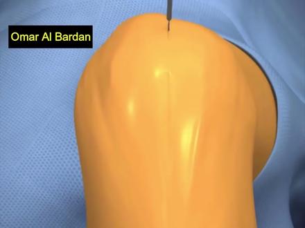 带你们直观了解膝关节置换手术#科普 #医学动画 #膝关节