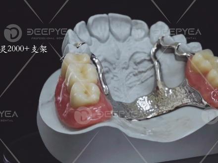 维他灵𝙑𝙞𝙩𝙖𝙡𝙡𝙞𝙪𝙢𝟮𝟬𝟬𝟬+支架
☑️高延展性,不易变形
☑️硬度较高,不易折断
耐磨抗腐蚀,紧密贴服↔️更好的保护基牙🦷