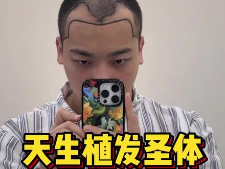 终于植发啦 困扰了这么多年的事终于解决了 #植发#男生植发#M秃