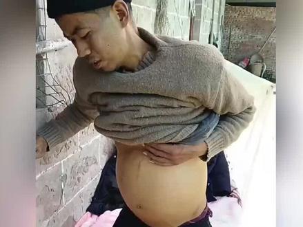 37岁抗癌网红张国勇因胆管癌去世,全身器官衰竭,肚子胀的像孕妇 #张国勇的抗癌日常