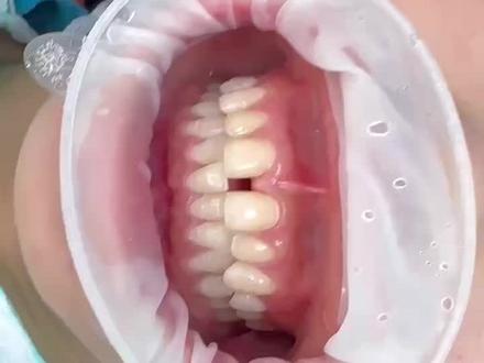 牙缝大看过来#牙贴面#牙贴面修复