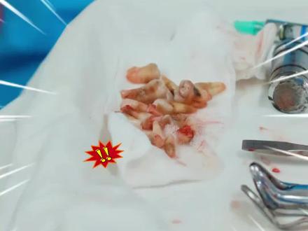 43岁!牙周炎没及时治,牙齿快掉完了,剩下的牙也松动严重! 牙周炎是成年人牙齿脱落的主要元凶,症状则呈现“递进式恶化”:初期延续牙龈炎的红肿出血,但随病情发展,会出现三大标志性特征:
(1)牙周袋形成:牙龈与牙根分离形成病理性盲袋,成为细菌滋生的“温床”,挤压时可见脓性分泌物溢出;
(2)牙齿松动:牙槽骨吸收导致牙齿支持力下降,咀嚼时出现咬合无力、牙齿移位,严重者牙齿可自行脱落,如同树根暴露的树木在风雨中摇晃;
(3)牙龈退缩:炎症导致牙龈缘向根方迁移,牙根暴露,出现牙齿敏感、牙缝增宽,甚至“黑三角”外观。
如果拖着不治,就会侵蚀牙齿根基,导致牙槽骨吸收,牙齿松动,脱落。#牙周炎 #牙齿松动 #种植牙 #种牙 #北大口腔