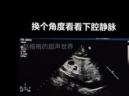 换个角度看看下腔静脉#超声学习 #心脏超声
