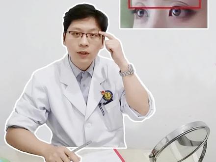 眼镜戴久了居然会出现这种情况?如果出现眼眶凹陷应该怎么处理?#眼窝凹陷 #眼窝填充 @抖音小助手