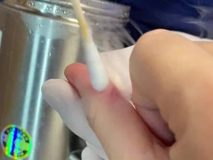 #液氮冷冻 的痛,只有试过的人才知道。如果你也像我一样怕疼,教你一个不疼的办法#丝状疣 #跖疣 #皮肤 #科普