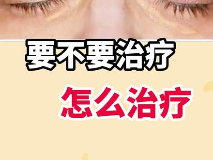 睑黄瘤 要不要治疗 怎么治疗 #睑黄瘤 #睑黄瘤怎么去除 #皮肤病 #抖出健康知识宝藏 #医疗健康创作训练营