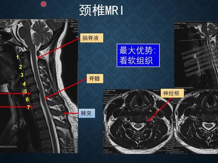 颈椎病到底要拍多少片子?它们真有用么?(第三集:颈椎核磁)