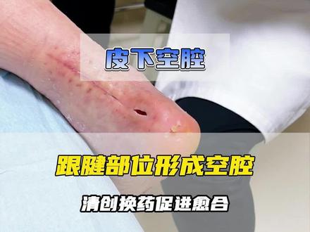 跟腱部位皮下形成空腔,创面愈合缓慢,清创换药加速肉芽生长 #医学科普 #慢性创面 #创面修复科魏伟 #抖出健康知识宝藏
