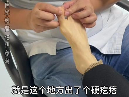 #拇外翻 #运动医学 #医学科普 老人家拇外翻,脚趾中间磨出茧子。