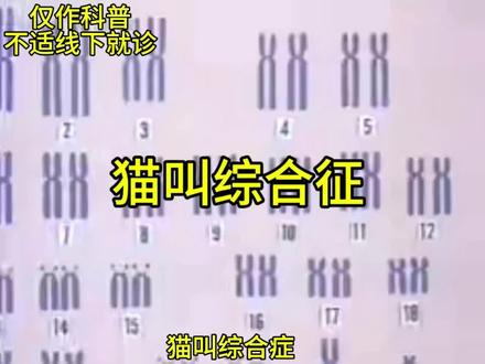 小儿猫叫综合征( cri - du - chat
syndrome ),又叫5p﹣综合征,是常染色体遗传病,主要病因为5号染色体的短臂部分或完全缺失,因患儿具有特征性的高调、猫叫样哭声而得名
母体妊娠前后受到辐射、感染、接触化学物品,以及高龄妊娠,都可能增加发生该病的可能。该疾病除特异性哭声外,患儿常伴有头面部畸形、智力障碍、生长发育迟缓、先天性心脏病等异常,患儿症状的严重程度与染色体缺失区域的大小及位置有关。因患儿免疫力低下,可并发各种感染及白血病等。
该疾病暂无有效的治疗方法,以对症治疗为主,治疗效果有限,如新生儿期吮吸和吞咽困难的患儿应早期予以鼻饲,外科修复各种畸形。#医学科普 #医生 #医学生 #护士 #猫叫综合症