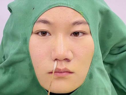 鼻翼缩小10mm,身份证真要换了
#鼻子#鼻翼外扩#缩鼻翼#鼻翼缩小#鼻翼疤痕
