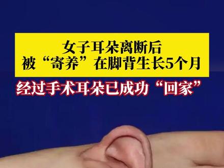 #女子左耳离断被寄养在脚背上 ,经过5个月的恢复和治疗,目前耳朵已成功“回家”!当事人:感谢医生给了我第二次生命!#媒体精选计划
