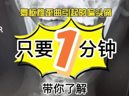 1分钟带你了解寰枢椎!#寰枢椎 #偏头痛 #疼痛科 #医学科普