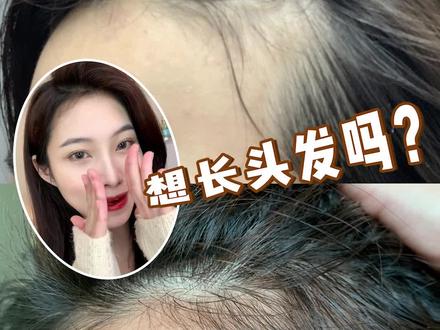 生发秘籍!我悟到了!半年生发打卡#生发 #防脱生发 @抖音小助手