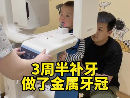 #儿童预成冠 3周半就变小钢牙了,真的不要像我一样,想等孩子大了配合了再弄牙齿,一定要定时检查牙齿。早发现,早治疗。#儿童龋齿