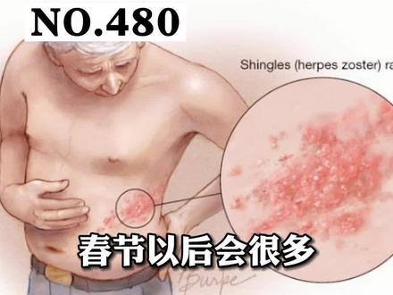 换季带状疱疹高发,孙叔提醒大家注意保暖呀~#科普 #皮肤 #蛇缠腰
