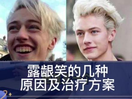 一笑就露出牙龈,是什么原因,可以矫正治疗吗?如何拯救一笑就毁容的尴尬?#牙齿矫正 #牙齿正畸 #露龈笑 #正畸 #笑得好看