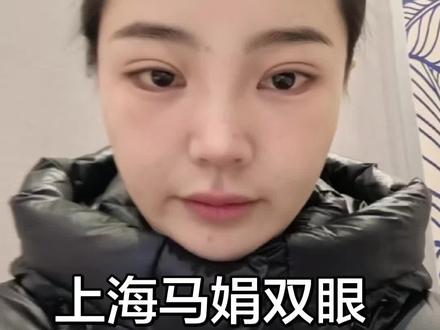马娟双眼皮修复第17天#马娟双眼皮 #马娟 #上海马娟双眼皮