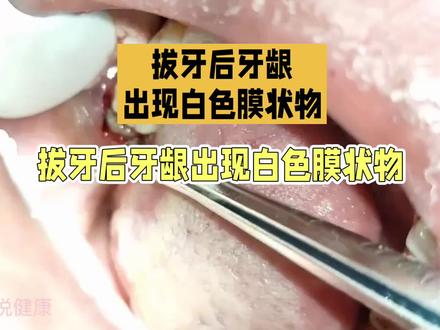 拔牙后创口的白膜是什么#拔牙创 口腔科普