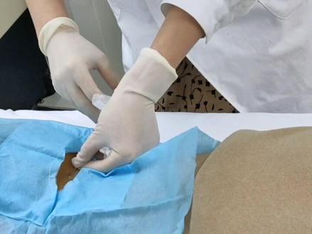 #造血干细胞移植 一年三个月。又到复查的日子了,跟大家分享#骨穿 全程拍摄。#白血病