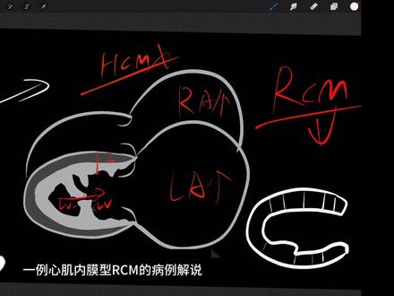 限制型心肌病解说。