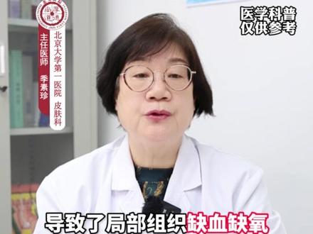 长冻疮痒的要命!医生教你一个小妙招处理!#冻疮 #止痒消肿 #硬核健康科普行动 #南方的冬天 #冻疮的形成原理