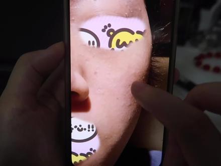 长脂肪粒是因为产品使用不当,水油平衡不好,不吸收引起的,要选择适合自己的产品 #脂肪粒 #调肤 #内调外控 #内调 #水油平衡