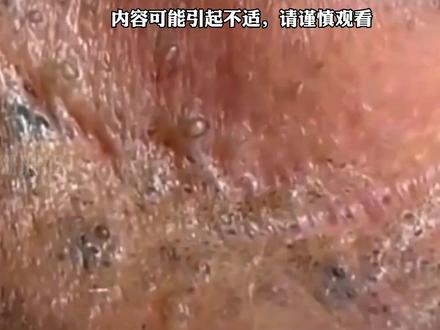 宝子们这期格外的饱满#护肤 #痘痘黑头粉刺拜拜 #细胞夹面部清理工具 #深层毛孔清洁 #解压