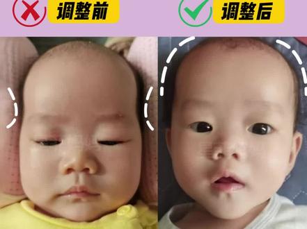 太阳穴凹陷怎么办!保姆级的教程
快来看看你们家宝宝是不是也有同样问题,太阳穴凹陷真的对宝宝的颜值很有影响,家长要引起注意啊#婴儿头型到底怎么睡 #睡头型 #圆头怎么睡出来的 #育儿经验分享 #宝宝头型