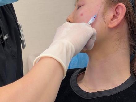 在上海花3vv不叨叨微调T区20提升方案,现场即刻太值了~ 镜人已签署肖像协议 仅为个案 此视频不宣导任何医疗项目 如有不适请及时就医 出镜人已满25周岁#面部提升 #面中凹陷 #上海注射医生 #鼻基底凹陷 #下巴后缩