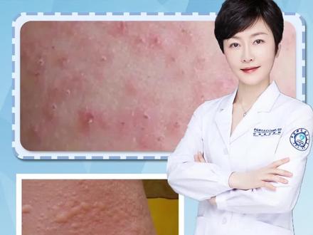 遇冷就过敏,浑身起疙瘩怎么办 #医学科普 #皮肤科 #荨麻疹