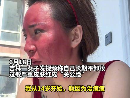 一定要正确使用化妆品!37岁女子长达20年化妆不卸妆 并多次医美,变成红肿“激素脸”#激素脸 #(来源:宁波晚报、绵阳日报 编辑:蔡盈辉 审核:张雷)