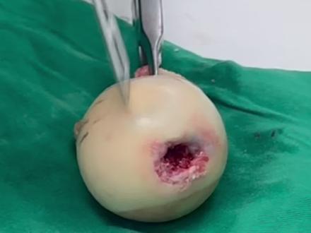 酒精型股骨头坏死 #股骨头坏死 #髋关节置换 #医学科普 #髋关节疼痛