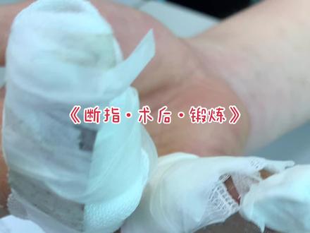 断指再植修复很重要 早期功能锻炼也重要#断指 #手外伤 #功能锻炼 #医学科普 #康复 #dou