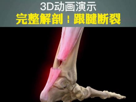 运动员有多难!跟腱断裂后即使经过系统的治疗,跟腱能如期愈合,但是也不会完全恢复的与以前一样。因为跟腱一旦产生断裂,无论从生理上还是从心理上,跟腱的功能都会有所下降。#东京奥运会 #跟腱断裂 @医视屏呼吸 @医阶