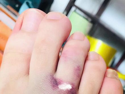 难怪清凉油越涂越痒了!医生20s教你认清处理#蚊虫叮咬 #蜈蚣 #蚊子包 #痒 #科普