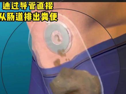 做完结肠造口手术后是如何排便的?#医学科普#健康#造口护理#造口人#肠道健康#医院#医生