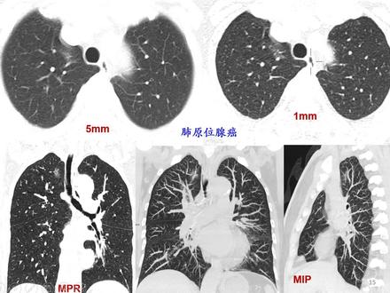 肺结节病例分享:CT薄层图像和多方位重组图像的重要性!