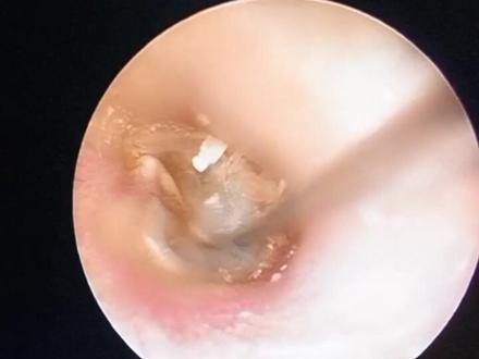 分泌性中耳炎的治疗方法之一#鼓膜穿刺。#医学科普 #分泌性中耳炎 #耳聋#耳鼻喉 #耳鼻喉杜玉晓@抖音小助手