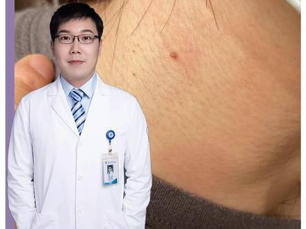 脖子上长了小揪揪,不要扣,这么办很简单!#dou来说健康#樊哥撩皮肤 #软纤维瘤 #医学科普 #小肉粒