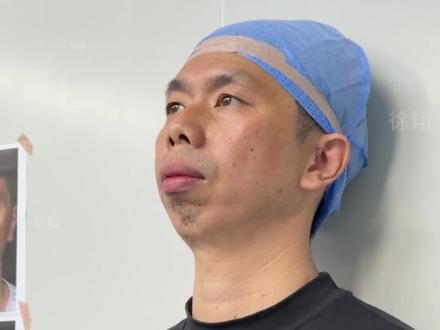 3D打印Peek假体改善极重度小颌畸形,拉出下巴调整轮廓 #peek下巴 #假体下巴 #下巴后缩 #3d打印 #广州徐翔